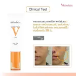 Vitamins, redness, acne marks - SKINSISTA V Acne Clear Facial Cream 30 ml