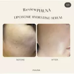Piauna Liposome Hydrating Serum. All ends. Acne problems, acne marks, oily skin formulas for