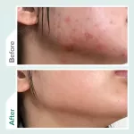 ของแท้ SOME BY MI AHA-BHA-PHA 30DAYS MIRACLE TONER 150 ml มิราเคิล โทนเนอร์ โทนเนอร์ลดสิว