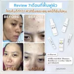 SET รักษาสิวอย่างตรงจุด