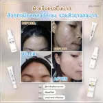 SET รักษาสิวอย่างตรงจุด