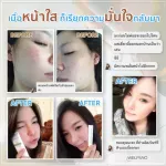 SET รักษาสิวอย่างตรงจุด