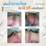 SET รักษาสิวอย่างตรงจุด