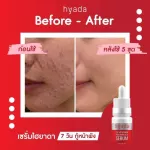1 get 1 free delivery !!! Hyda serum serum, acne * Expired 06/02/23 * Hyada Go-VC Vitamin Hyaluronic Acid Serum, facial skin serum.