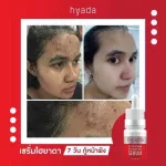 1 get 1 free delivery !!! Hyda serum serum, acne * Expired 06/02/23 * Hyada Go-VC Vitamin Hyaluronic Acid Serum, facial skin serum.
