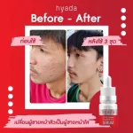 1 get 1 free delivery !!! Hyda serum serum, acne * Expired 06/02/23 * Hyada Go-VC Vitamin Hyaluronic Acid Serum, facial skin serum.