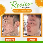 Free delivery !! Queen queen serum, radish serum, reduce melasma, dull face, acne, acne, steroids, acne, reduce wrinkles