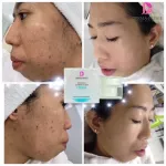 ครีมบำรุงสำหรับคนเป็นสิว ลดการเกิดสิว ไม่สร้างหลุมเพิ่ม