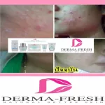 ครีมบำรุงสำหรับคนเป็นสิว ลดการเกิดสิว ไม่สร้างหลุมเพิ่ม