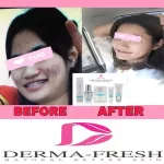 ครีมบำรุงสำหรับคนเป็นสิว ลดการเกิดสิว ไม่สร้างหลุมเพิ่ม