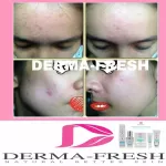 ครีมบำรุงสำหรับคนเป็นสิว ลดการเกิดสิว ไม่สร้างหลุมเพิ่ม