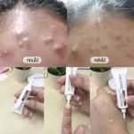 Welpano Acne Gel 2 หลอด