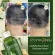 Khun Dej Herbal Shampoo, Reduction of the scarring, scarring, scarring