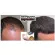 เคิร์กแลนด์ชนิดโฟม 60g ต่อขวด Hair Regrowth Treatment Foam 60 g Kirkland®