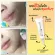 Welpano Acne Gel acne gel