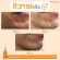 Clean skin without acne - Skinsista V Clear Booster 15 ml. Free V Acne Clear Cleansing Gel 100 ml.