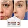 See the results clearly, the scars are all gone, the cream reduced the scar, reducing the burns, burns, scalds. Surgical wound, etc. Scar (scar removal cream Gel to reduce scars Acne reduction cream)