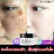 SAY NO and the blemish on the face! Cream, blemish, blemish cream, reduce melasma Inhibits the growth of melanin Makes the skin white, clear, blemish cream, blemish treatment